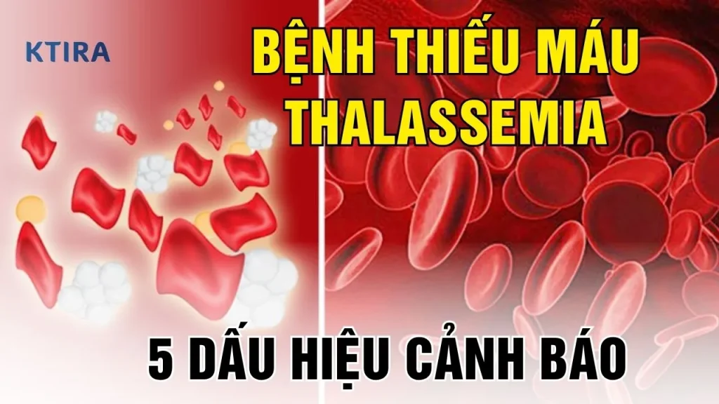 Bệnh Thiếu Máu Thalassemia KTIRA
