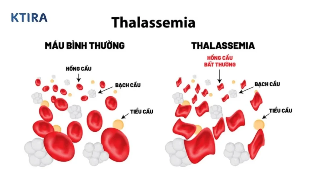 Bệnh Thiếu Máu Thalassemia là gì? KTIRA