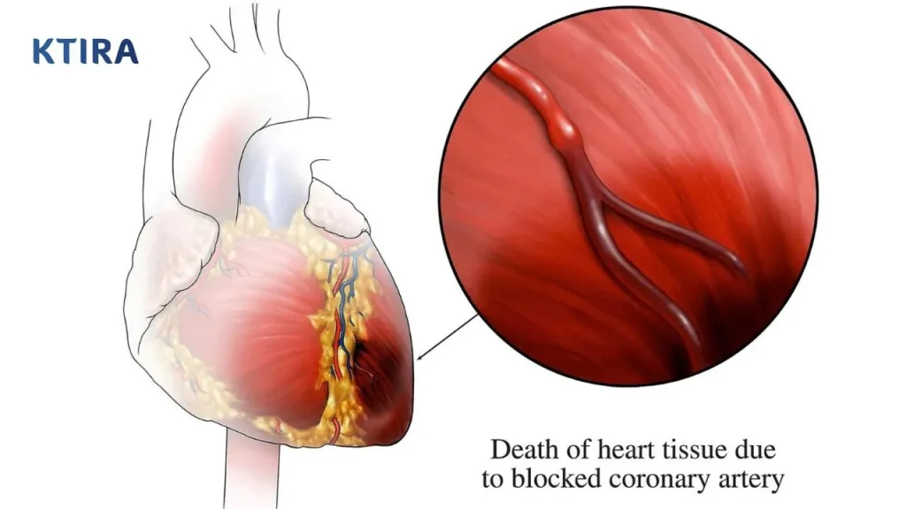 Bệnh Tim Thiếu Máu Cục Bộ Mạn Là Gì? KTIRA 