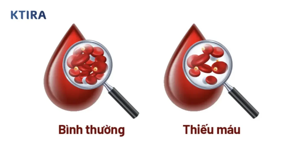 Thiếu máu nên khám gì trước tiên? KTIRA KTIRA