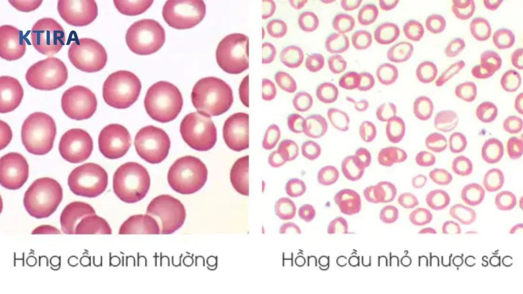 Thiếu Máu Hồng Cầu Nhỏ Nhược Sắc KTIRA 
