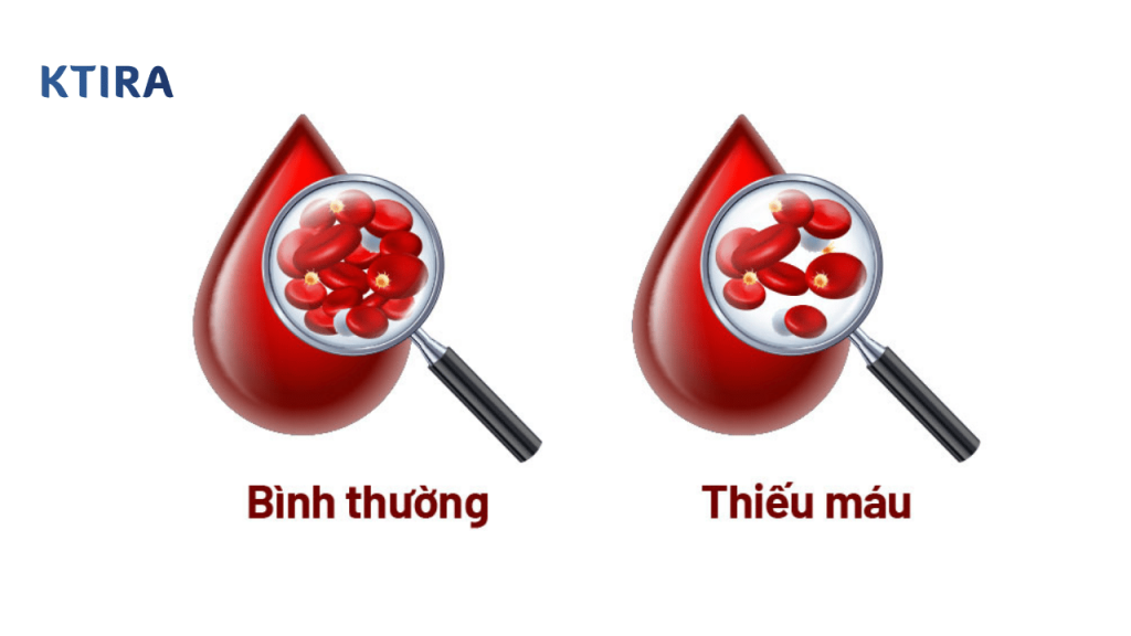 Thiếu máu là gì? KTIRA 