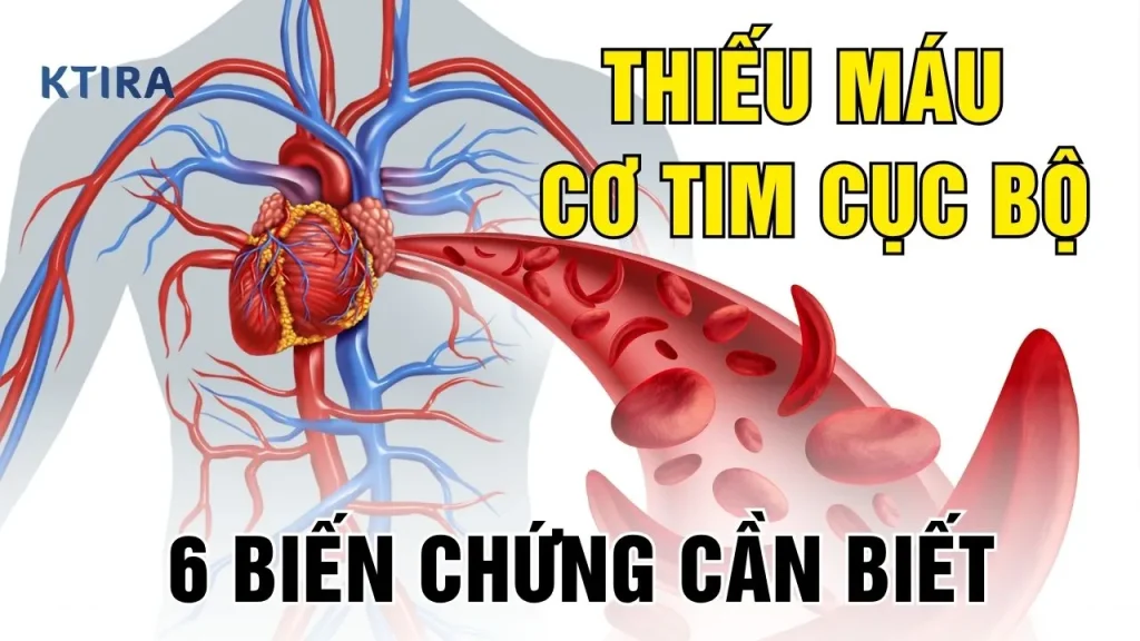 Thiếu máu cơ tim cục bộ KTIRA