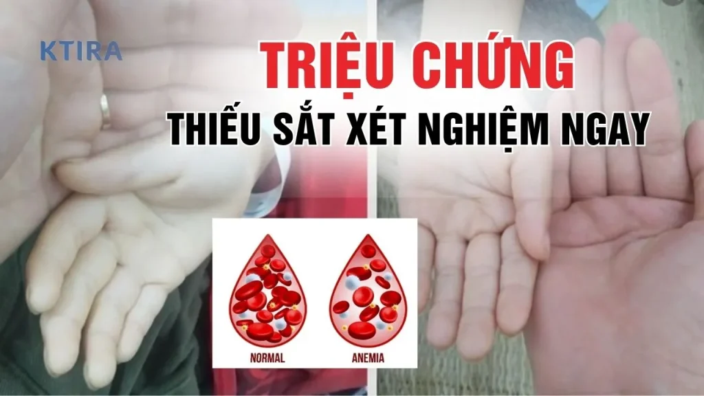 Triệu chứng thiếu sắt KTIRA