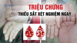 Triệu chứng thiếu sắt KTIRA